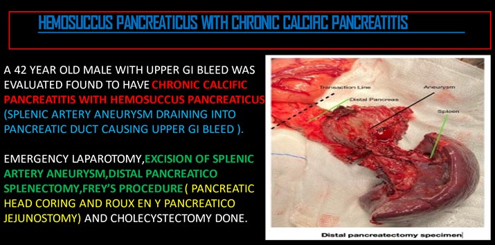 HEMOSUCCUS PANCREATICUS WITH CHRONIC CALCIFIC PANCREATITIS