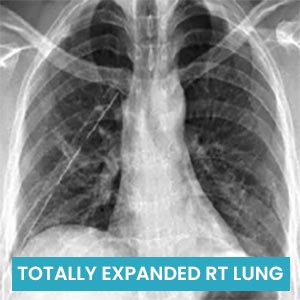 TOTALLY EXPANDED RT LUNG