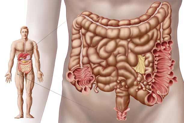 3 Facts of Diverticulitis