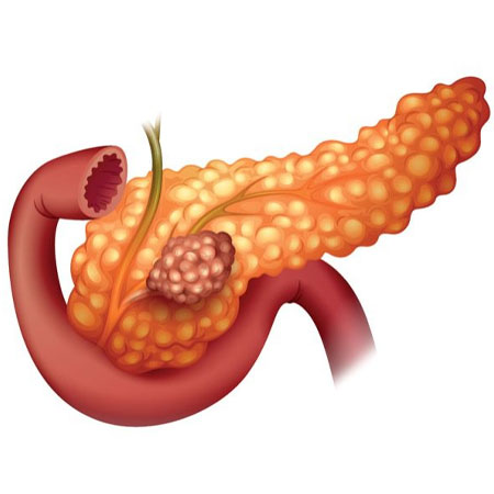 Pancreatic malignancies in Hyderabad