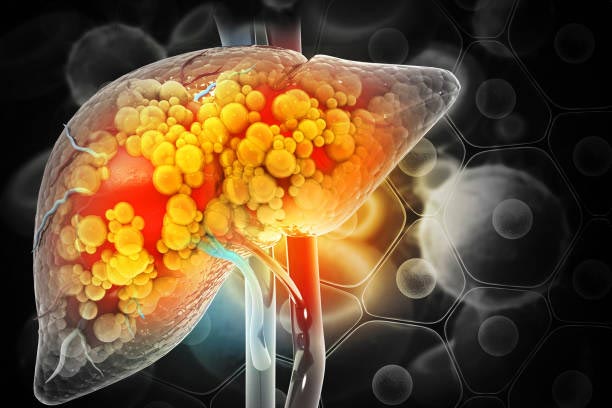 Liver disease treatment in Secunderabad