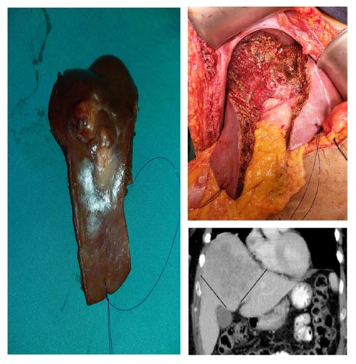 CENTRAL HEPATECTOMY