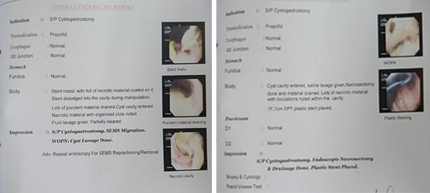 ARDS with Respiratory failure