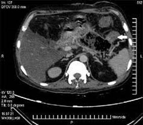 PANCREATICOCOLIC FISTULA