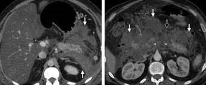 acute necrotising pancreatitis with CTSI