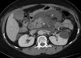 endoscopic measures