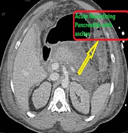 Acute-Pancreatitis-with-Ascites