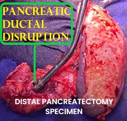 DISTAL PANCREATECTOMY SPECIMEN