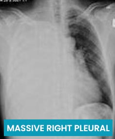 MASSIVE RIGHT PLEURAL