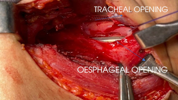 laparoscopic feeding jejunostomy