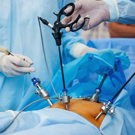 Laparoscopic Surgeries