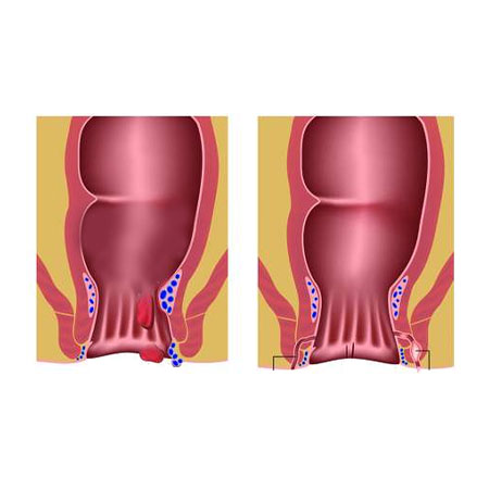 Perianal Diseases